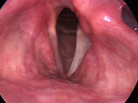 bilateral vocal cord paralysis